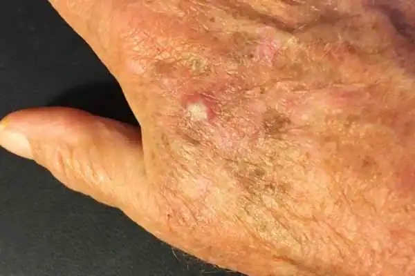 Cryopen For Actinic Keratoses 1 Image of Actinic keratoses Kent on a person hand