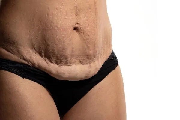 The Science of Skin Tightening 1 The science behind skin tightening Kent picture of a woman's sagging skin on the stomach